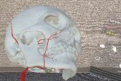 3D image of skull using CT data